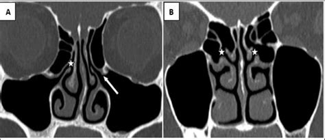 Osteomeatal Complex Radiology