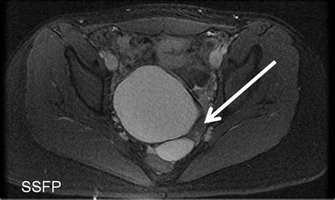 Ovarian Dermoid Cyst MRI | RADIOLOGYPICS.COM