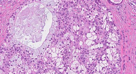 Mucoepidermoid carcinoma (MEC) - MyPathologyReport.ca