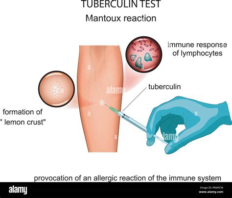 Mantoux Test Principle, Procedure, Interpretation And, 60% OFF