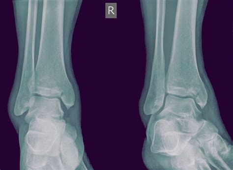 Medial Malleolus Fracture and Broken Ankle Treatment