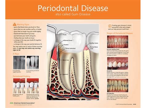 ADA Store - Periodontal (Gum) Disease Chart