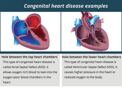 Congenital Heart Defects Symptoms