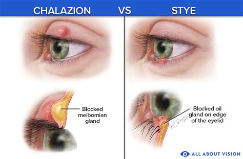 Meibomian Gland Cyst