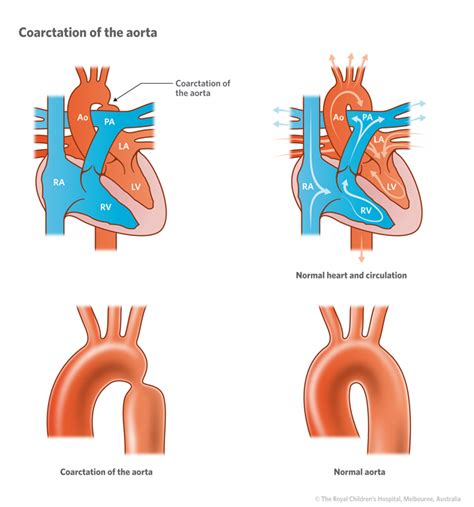 Cardiology : Coarctation of the Aorta