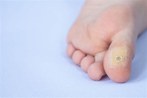 Plantar Wart-On-Toe Removal Surgery: Comprehensive Guide