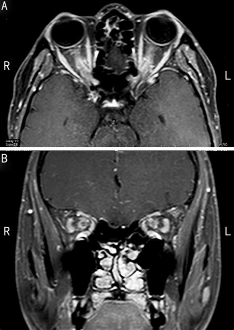 Contrast-enhanced MRI showing marked enhancement of the optic nerve ...