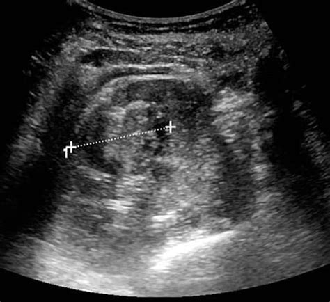 Renal Cancer - Clinical Features - Management - TeachMeSurgery