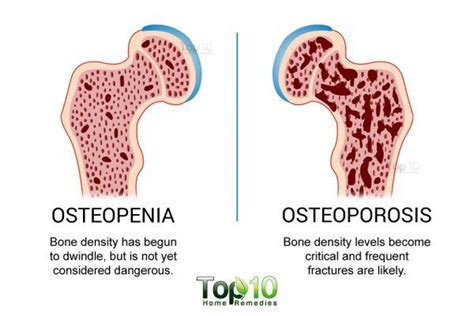 How to Prevent Loss of Bone Mineral Density (Osteopenia) | Top 10 Home ...