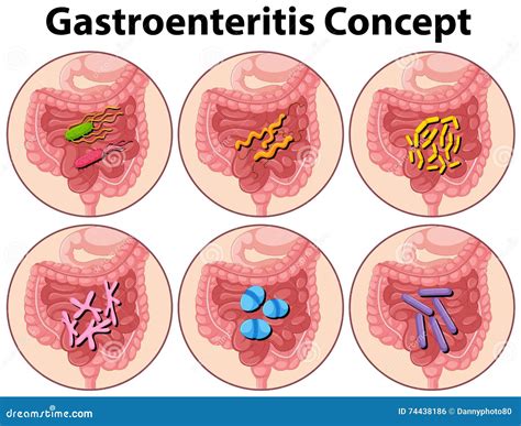 Diagram Showing Gastroenteritis Concept Stock Vector - Illustration of ...