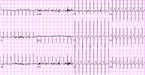 Pediatric SVT