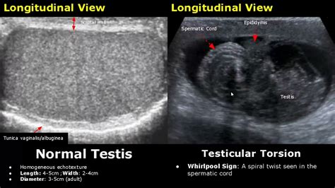 Normal Epididymis Ultrasound