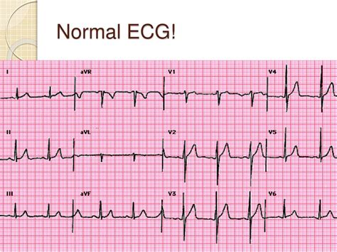 Detailed Components Of Ecg Chart