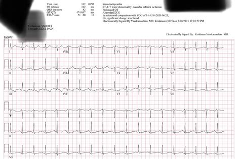 How do you hand calculate the qtc interval on this ekg? : r/EKG