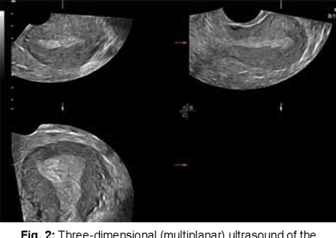 Figure 2 from Ultrasound Imaging of Postpartum Hemorrhage | Semantic ...