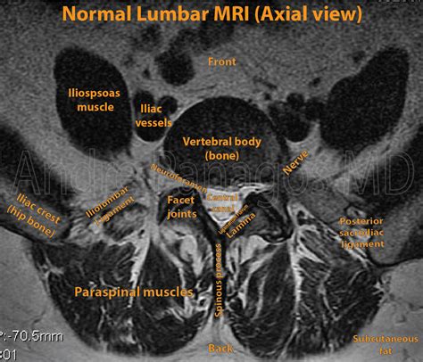 Healthcare Extreme How To Read An MRI Lumbar Spine In 8 Easy Steps