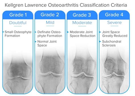 Guide to Severe Knee Arthritis (Tricompartmental Osteoarthritis ...