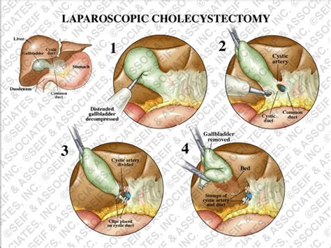 Laparoscopic Cholecystectomy | General Surgical Nursing | Pinterest