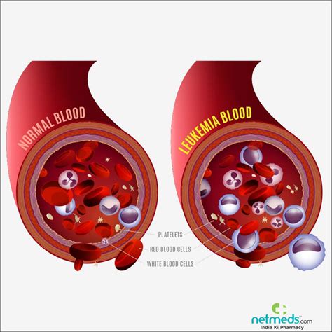 Blood Cancer / Leukemia: Causes, Symptoms And Treatment | Netmeds