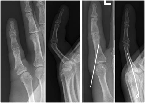 Proximal Phalanges