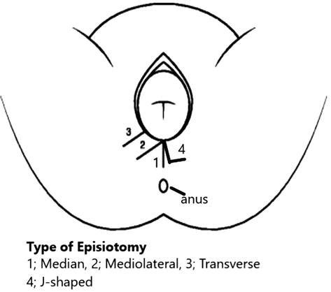 Episiotomy - Midwives Revision