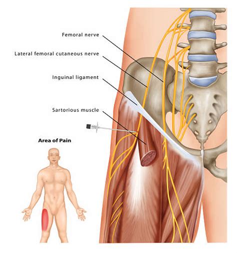 Lateral Femoral Cutaneous Nerve Dermatome