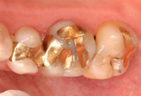 Your Guide To The 5 Different Types of Dental Filling - The Frisky