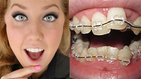 Clear Bracket Braces Before And After