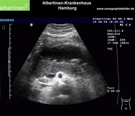 Acute Pancreatitis Ultrasound