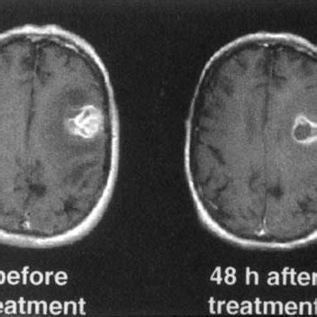 T1-weighted and contrast-enhanced MRI (left) before | Download ...