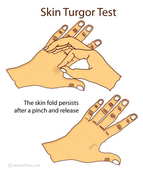 Normal and Poor Skin Turgor: Definition, Assessment, Scale | eHealthStar