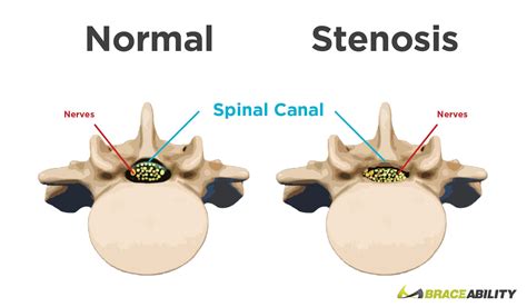 Lumbar Spinal Stenosis | Symptoms, Surgery, Exercises & Treatment