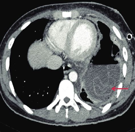 CT scan of the chest with contrast showing a 6 x 6 cm cyst at the left ...