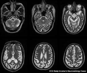 Dr Balaji Anvekar's Neuroradiology Cases: Posterior cortical atrophy ...