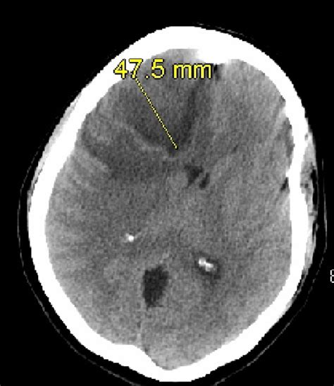 Brain Abscess Due to Streptococcus intermedius Infection | Consultant360