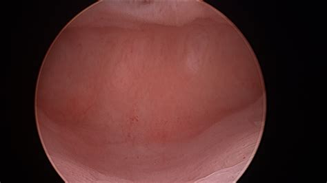 Hysteroscopy Surgery — WA GynaeScope | Gynaecologists | Fertility ...