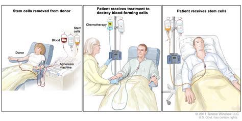 Stem Cell Transplants in Cancer Treatment - National Cancer Institute