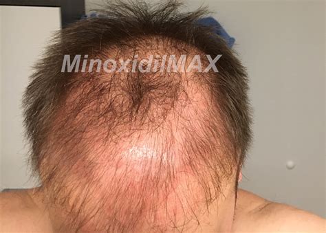 Minoxidil Results | Before & After Amazing Pictures