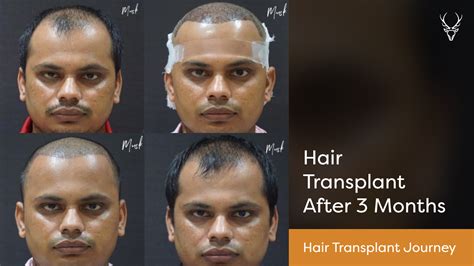 Aggregate more than 64 shedding after hair transplant super hot - vova ...