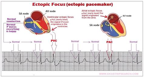 ectopic focus