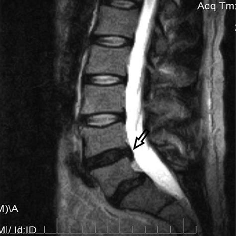 Sagittal MRI demonstrates L4-L5 disc extrusion. | Download Scientific ...