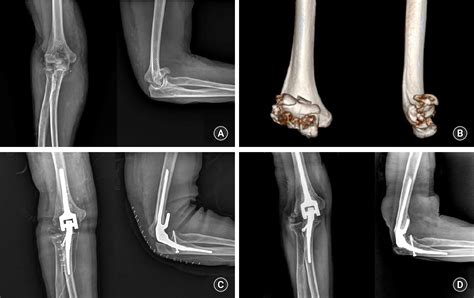 Table 1 from Primary Total Elbow Replacement for Treatment of Complex ...