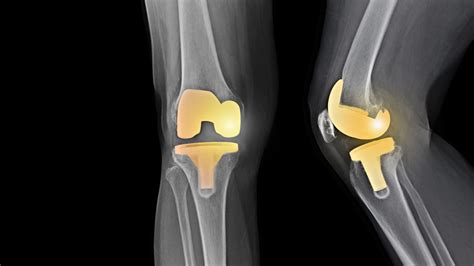 New Knee Replacement Technology 2024 - Babara Kordula