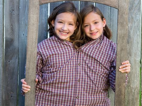 Conjoined Twins - Care Options for Kids