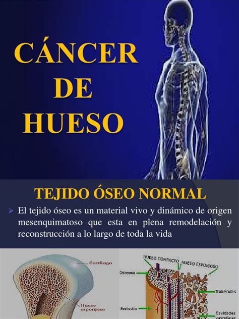 Cáncer de Hueso | PDF | Cáncer | Hueso