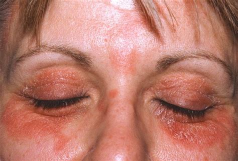 Eczema on Eyelids Causes, Treatments and Cures | Skincarederm