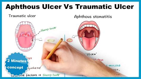 Aphthous Stomatitis