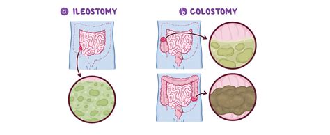 Ileostomy Vs Colostomy