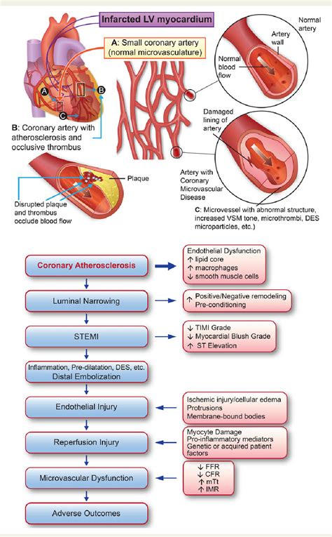 [PDF] The Coronary Microcirculation in STEMI: The Next Frontier ...