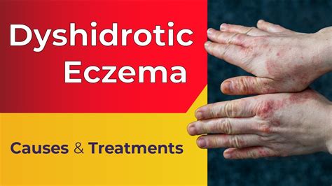 Dyshidrotic Eczema Nails